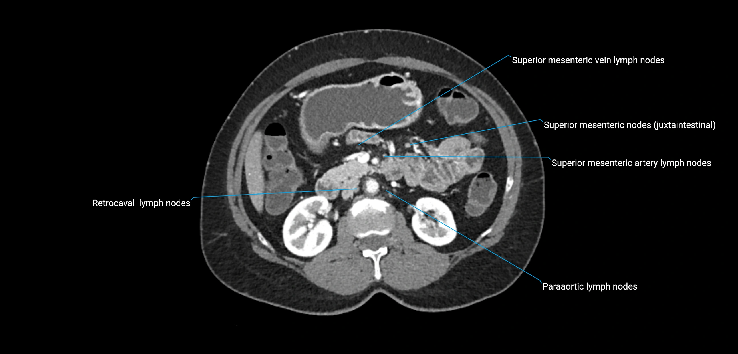 CT ct abdominal lymph nodes  axial cross sectional anatomy  enchanced radiology image -img-00002-00187.webp